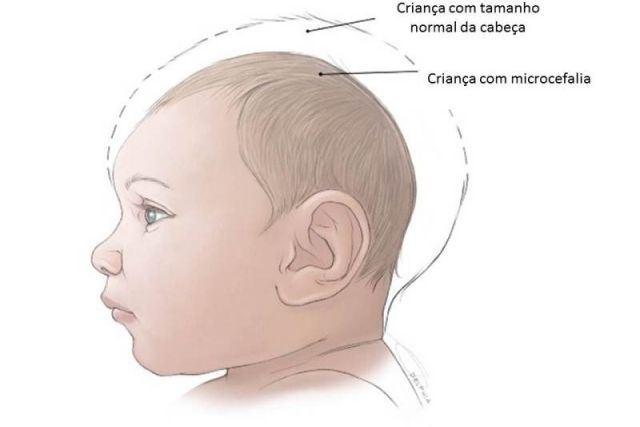 Microcefalia detectada em 12 cidades do  estado. Juara é atingida.