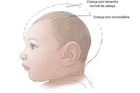 Microcefalia detectada em 12 cidades do  estado. Juara é atingida.