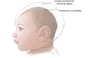 Microcefalia detectada em 12 cidades do  estado. Juara é atingida.